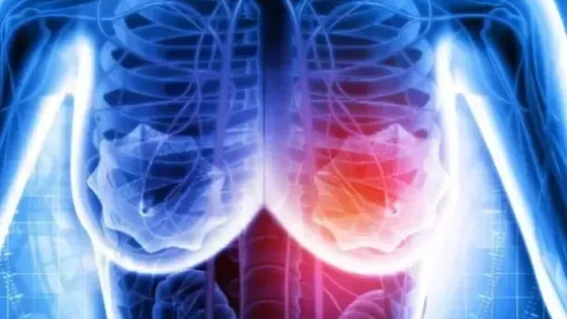 Mujer tenía dolor de espalda, pensó que era estrés, pero le diagnosticaron cáncer