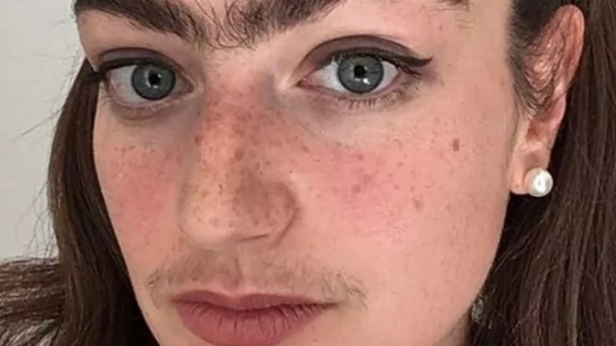 hiperandrogenismo