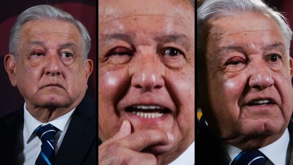 El presidente apareció con un ojo inflamado por un orzuelo