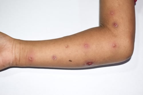 Nuevo León tiene cinco casos sospechosos de viruela del mono, además de los dos confirmados