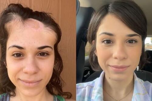 Tiktokera sobreviviente de cáncer mostró su increíble proceso de recuperación