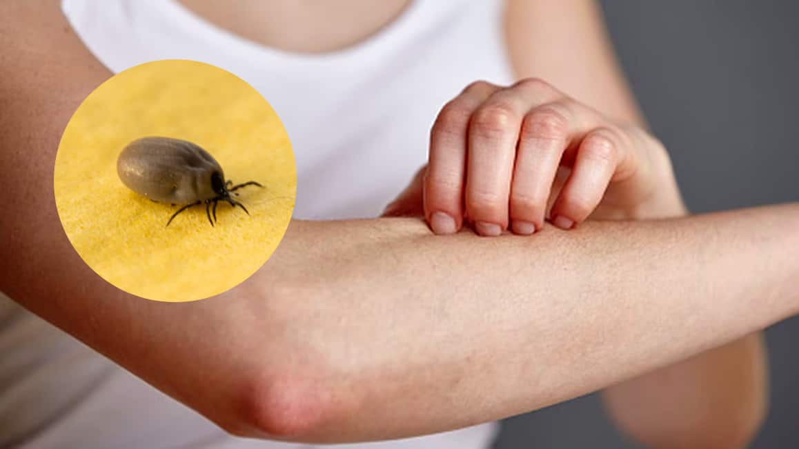 Babesiosis ¿Qué es y cómo prevenir la enfermedad que se propaga rápidamente en EU?