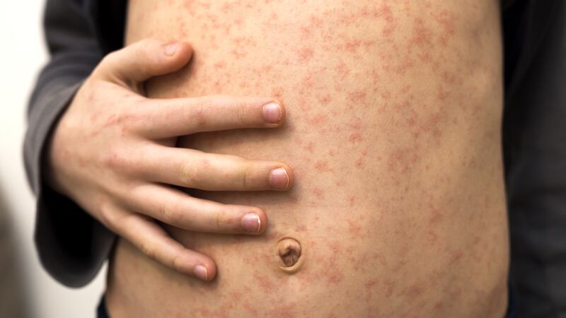 Se ha presentado un aumento de casos importados. (Dreamstime)