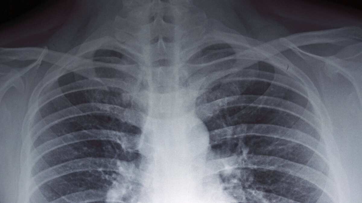 La enfermedad ha provocado muertes en Argentina. (Dreamstime)