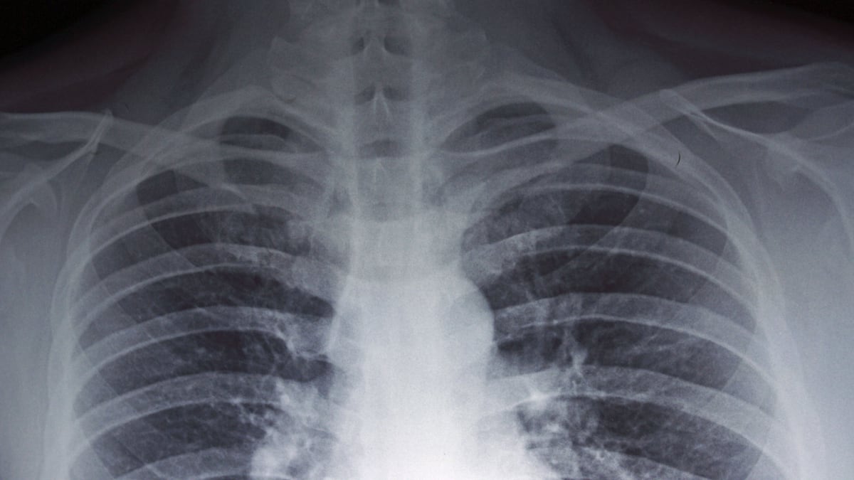 La enfermedad ha provocado muertes en Argentina. (Dreamstime)