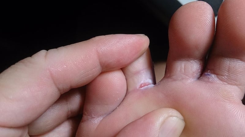 El pie de atleta es una infección fúngica en la piel que, por lo general, comienza entre los dedos de los pies. Foto: Medical News.