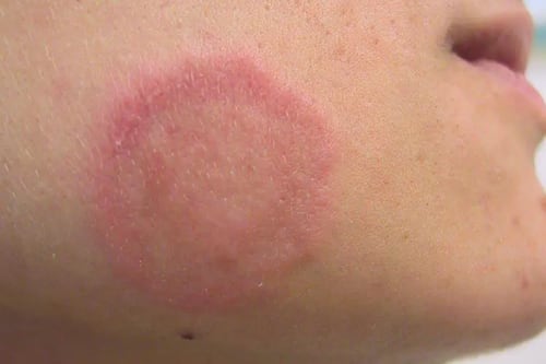 ¿Qué es la tiña de transmisión sexual? La rara enfermedad detectada por primera vez en EE.UU.