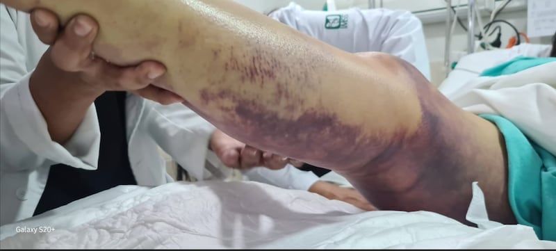 Mordedura de vibora
