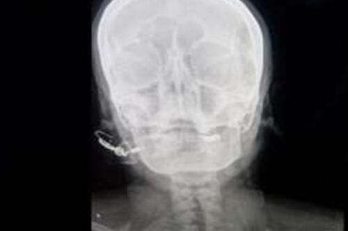 Curandero inserta clavo en cráneo de mujer embarazada para dar a luz a un varón