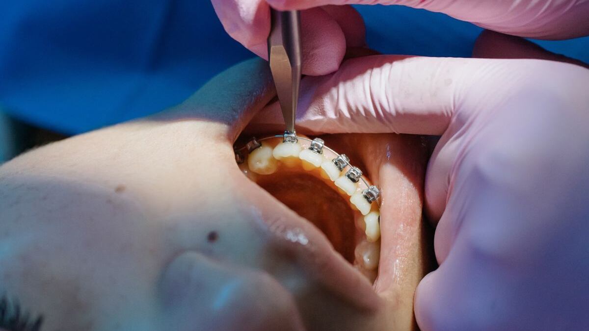 Mexicanos son indiferentes a la salud bucodental; 93.3% de la población sufre de caries