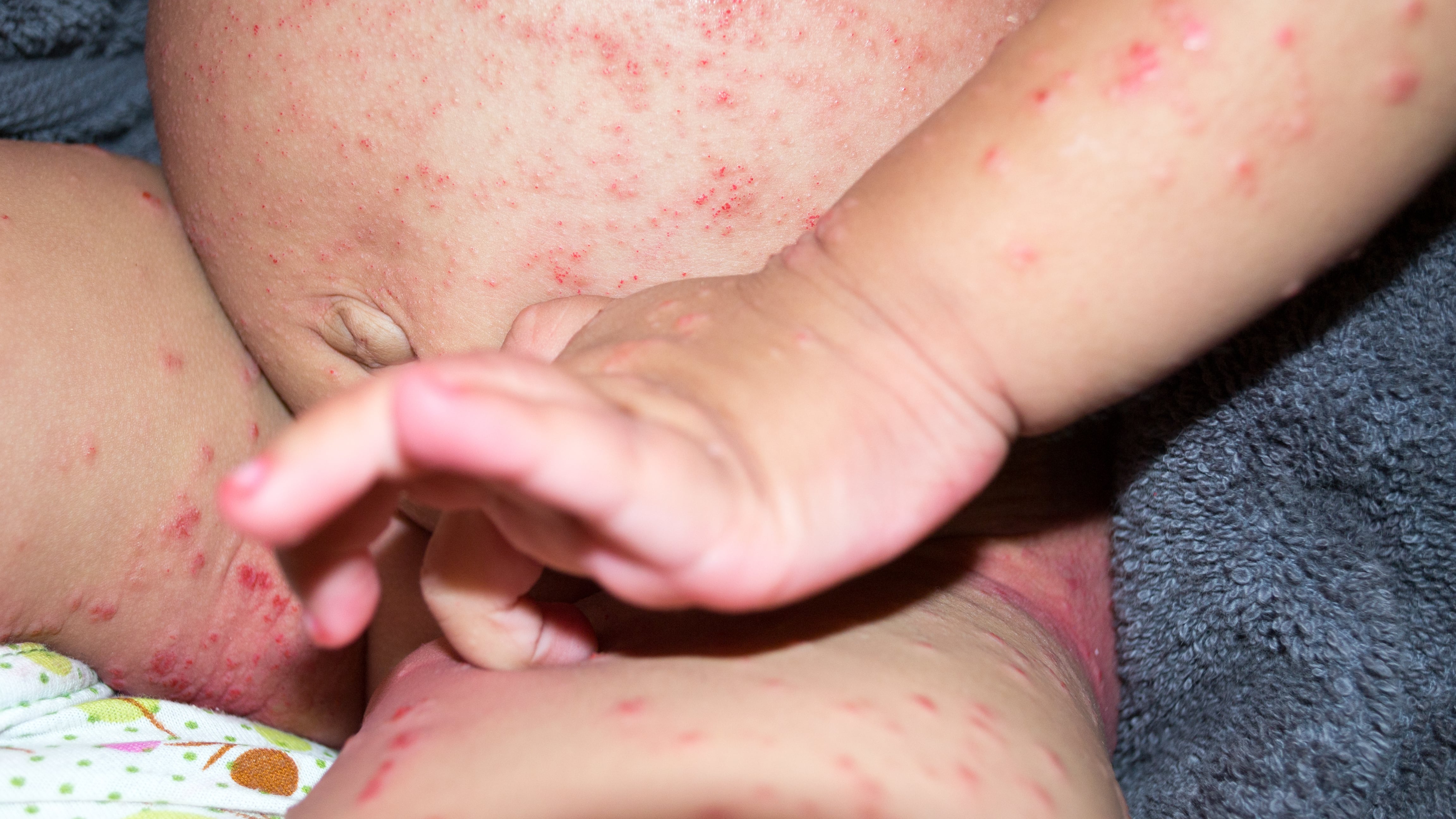 ¿Qué es escabiosis, contagiosa enfermedad que alerta por posible brote?