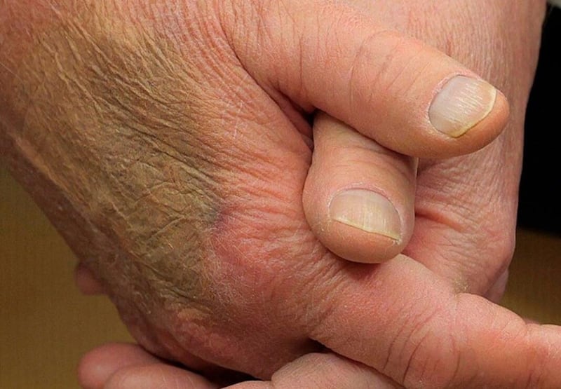 Hematoma en mano de Trump