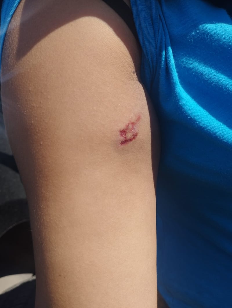La víctima presentaba mordidas en un brazo.