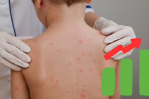 Jalisco suma dos mil 429 casos de sarampión; casi el doble en una semana y lidera contagios