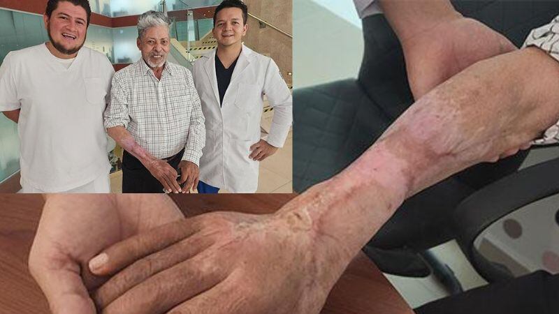 IMSS salva brazo de abuelito picado por araña violinista en Aguascalientes