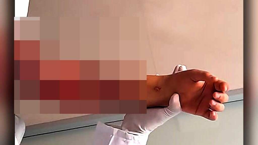 La menor de edad se encuentra internada en el centro médico nacional de occidente en espera de diferentes cirugías para la reconstrucción de su cuerpo.