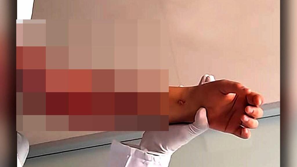 La menor de edad se encuentra internada en el centro médico nacional de occidente en espera de diferentes cirugías para la reconstrucción de su cuerpo.