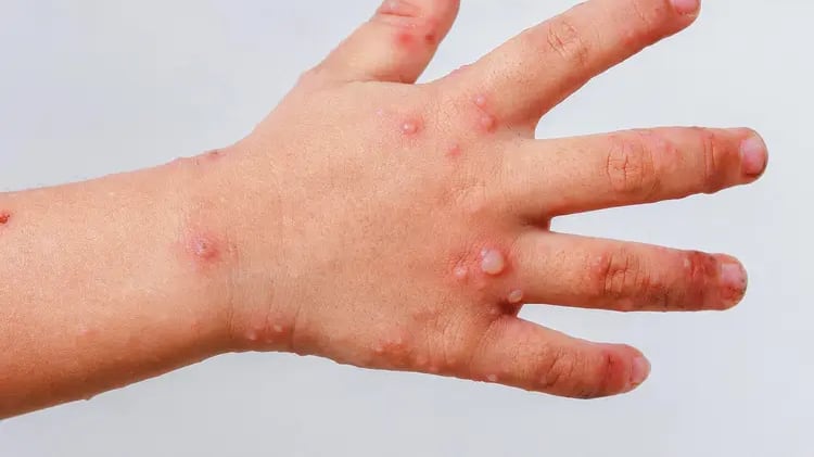 Detectan 8 casos de virus Coxsackie