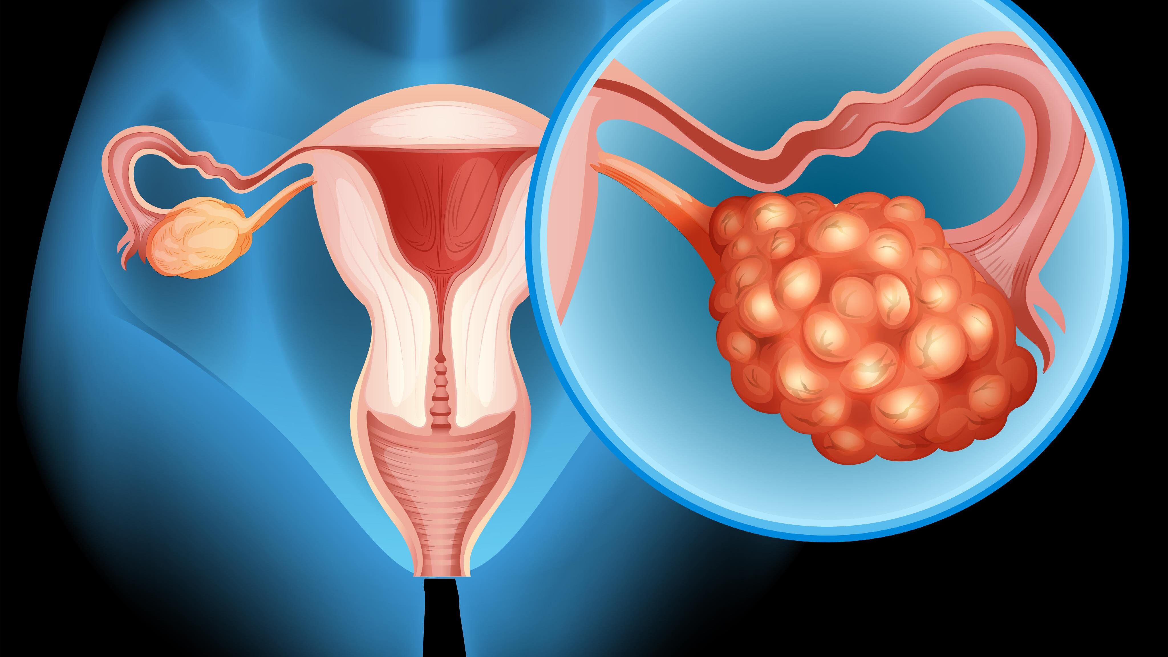 El cáncer de ovario tiene una mayor letalidad y sus síntomas pueden confundirse fácilmente con otros trastornos comunes.