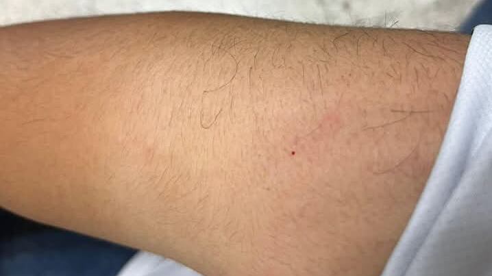 En esta imagen se aprecia el piquete en un brazo del estudiante de prepa.